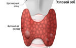 К развитию атеросклероза может привести высокий уровень гормона щитовидной железы