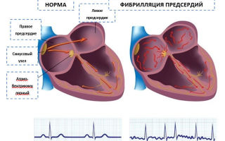 Отказ от алкоголя улучшает течение фибрилляции предсердий