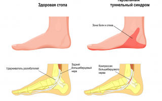 Зарядка в офисе: профилактика туннельного синдрома