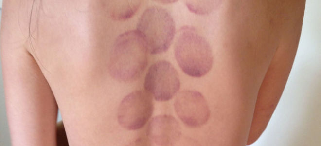 Банки на спину — польза и вред