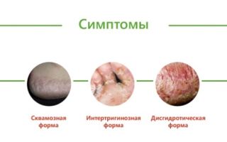 Профилактика грибковых инфекций: микоз стопы