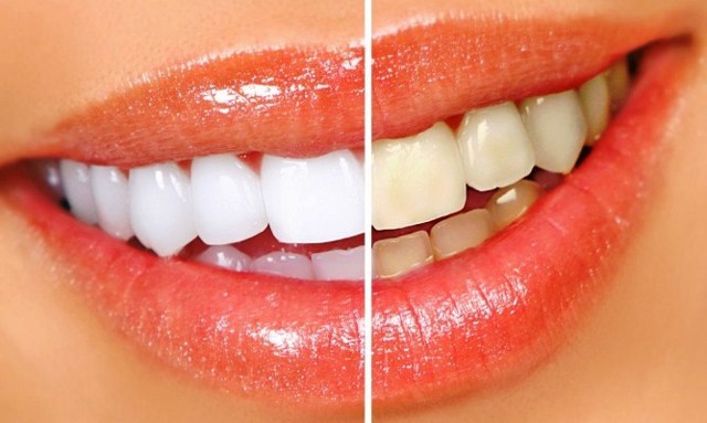 Перекись водорода для зубов: чем полезна и чем вредна