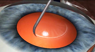 Жидкокристаллический хрусталик поможет сохранить здоровые глаза пожилым