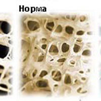 Чернослив защищает от остеопороза