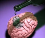 Алкогольное поражение мозга: корсаковский синдром