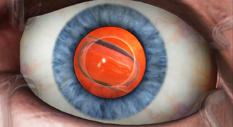 Жидкокристаллический хрусталик поможет сохранить здоровые глаза пожилым