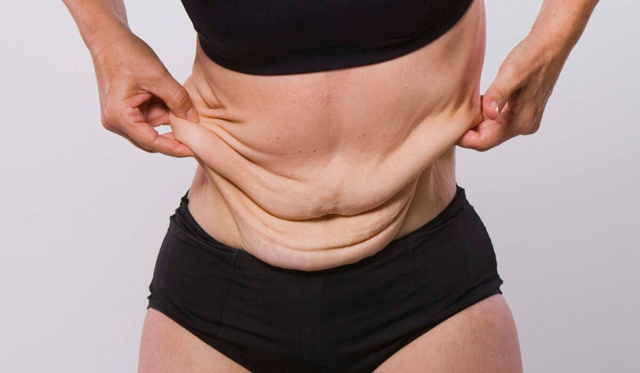 Лишний вес может привести к проблемам с кожей