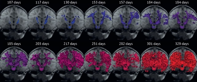 Анализ детского мозга продемонстрировал удивительные особенности изменения структуры сна