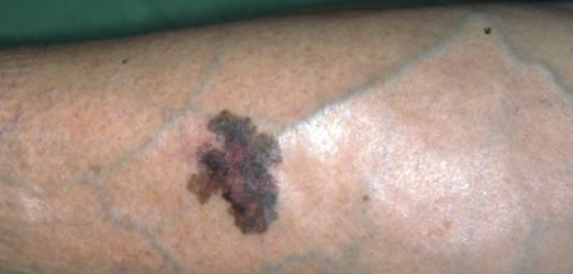 Солярии повышают риск развития рака кожи на 20 процентов