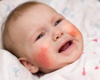 Риск аллергии в младенчестве.