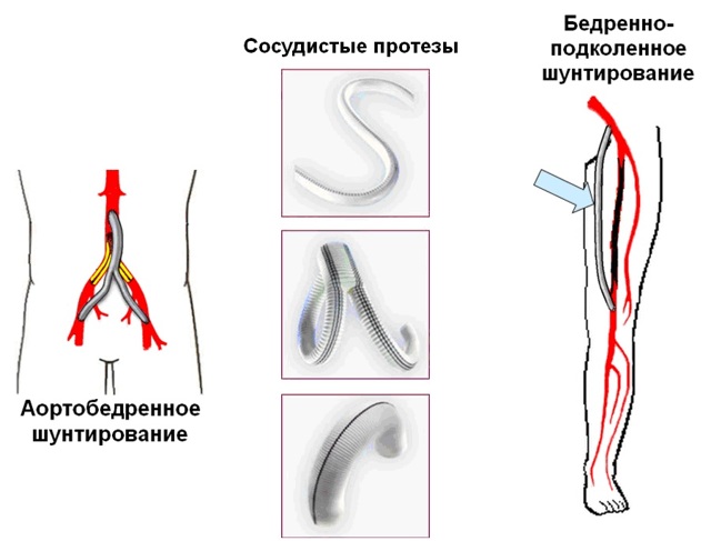 Заболевание аорты и периферических артерий