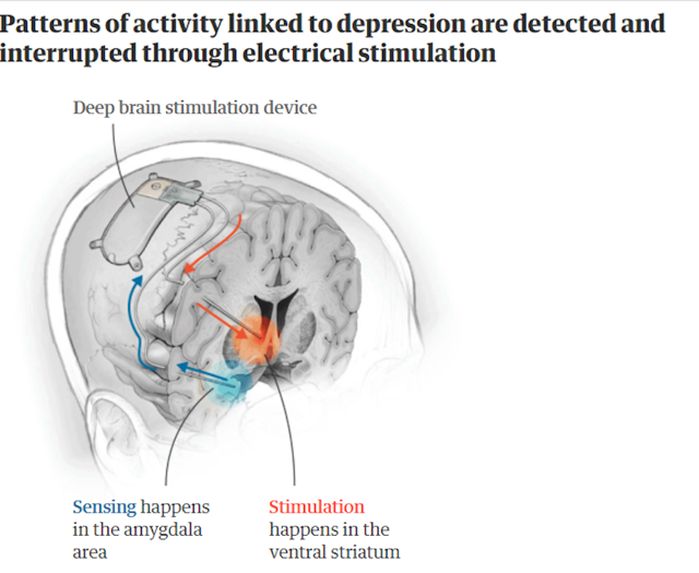 Исследователи пересмотрели взгляд на лечение депрессии