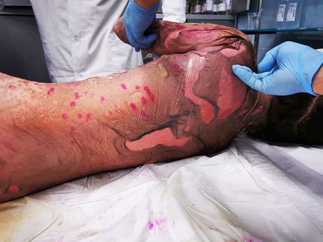 В Кирове врачам удалось спасти человека, у которого было обожжено 50% кожи