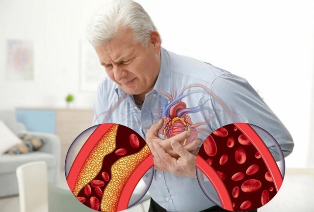 Пища, способствующая воспалению, увеличивает риск болезней сердца и инсульта