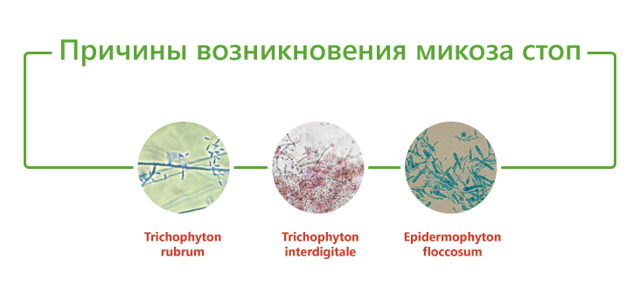 Профилактика грибковых инфекций: микоз стопы