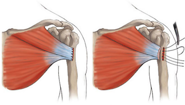 Растяжка мышц боковой поверхности груди