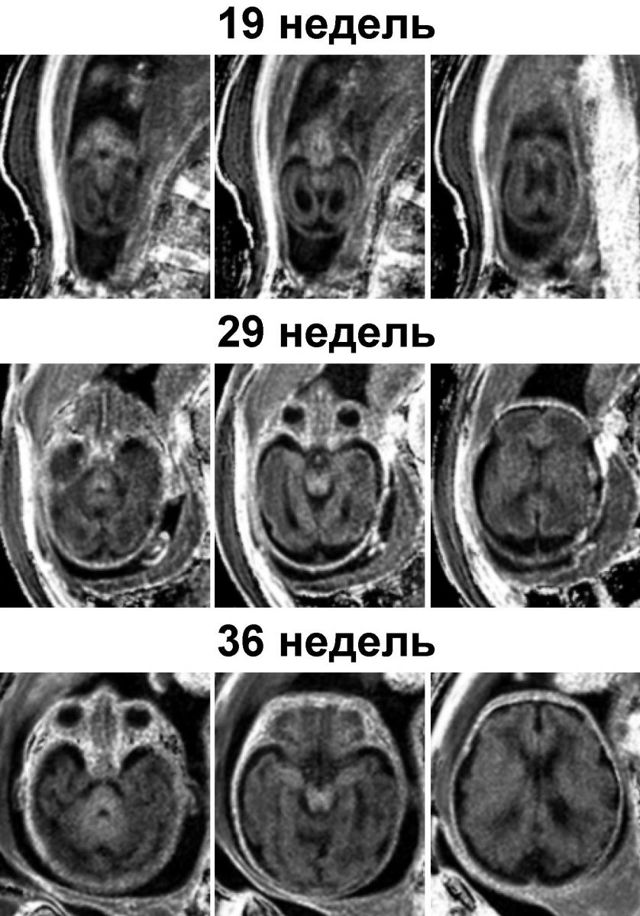 В России ученые смогли проследить за развитием мозга у плода в утробе матери